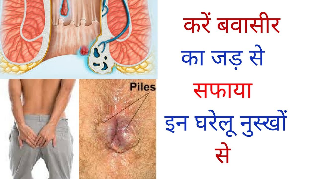 बवासीर की असली वजह जानकर चौंक जाएंगे! अगर समय पर नहीं संभले तो बढ़ सकती है बड़ी बीमारी बवासीर की असली वजह जानकर चौंक जाएंगे! अगर समय पर नहीं संभले तो बढ़ सकती है बड़ी बीमारी